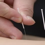 Acupuntura